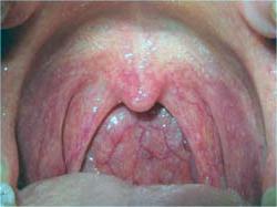 Lėtinis faringitas suaugusiems - simptomai ir gydymas