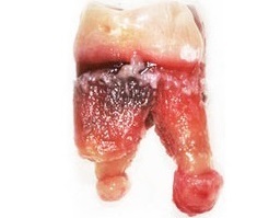Zyste an der Wurzel der Zahnsymptome