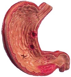 Gastric ulcer treatment