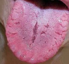 Cracks in tongue treatment
