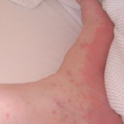Allergic urticaria on the leg