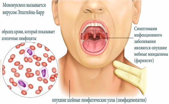 Infectious mononucleosis in children - symptoms and treatment