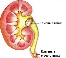 Stones in the kidneys