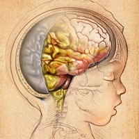 Zapalenie opon mózgowych - objawy u dorosłych i dzieci, leczenie