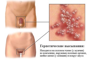 Herpes genitale in uomini e donne