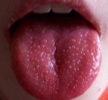 Scarlet fever in adults
