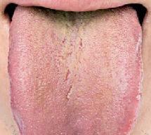 Revestimento verde na língua