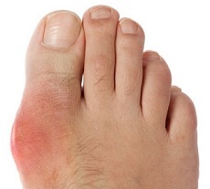 wat is voetartritis