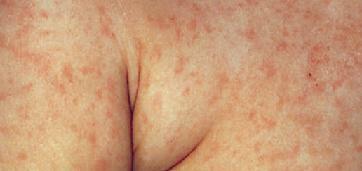 Rubella in adults: photos, symptoms and treatment, prevention