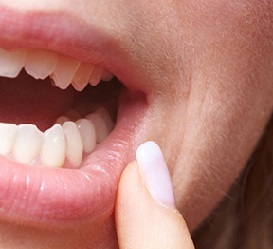 Stomatitis in adults - treatment at home, photo