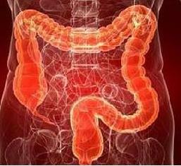 Crohn's disease