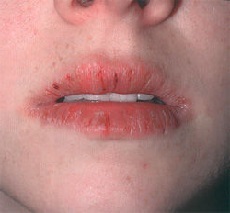 Heilith - causes, photos and treatment