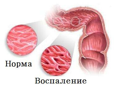 Síntomas de la enfermedad de Crohn