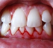 Zahnfleischbluten
