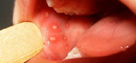 التهاب الفم عند الأطفال - الصور والأعراض والعلاج في المنزل