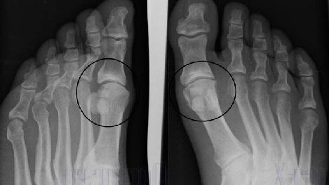 Foto da artrose do pé em um raio X.