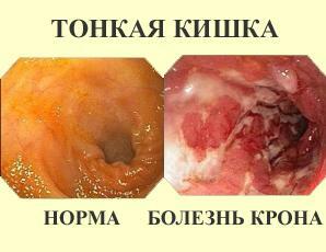 Forårsaker Crohns sykdom
