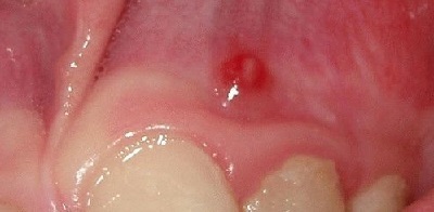 Cista ant danties šaknies - simptomai, gydymas, pašalinimas