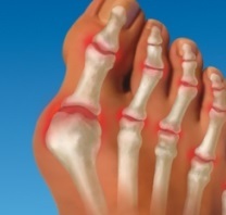 Hueso en el dedo gordo del pie
