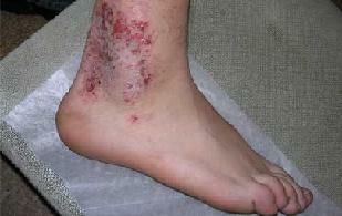 Microbial eczema on the hands and feet