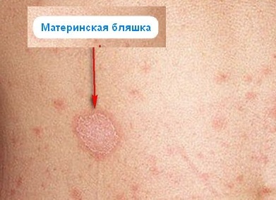 Lichene rosa negli umani: cause e trattamento, foto