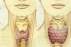Hypothyroidism - what is it? Symptoms, causes and treatment