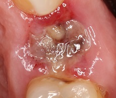 Alveolitída po extrakcii zubov - príznaky a liečba