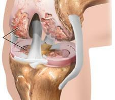 Artrite dei sintomi articolari del ginocchio