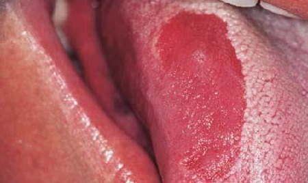 Glossitis Tongue tünetei