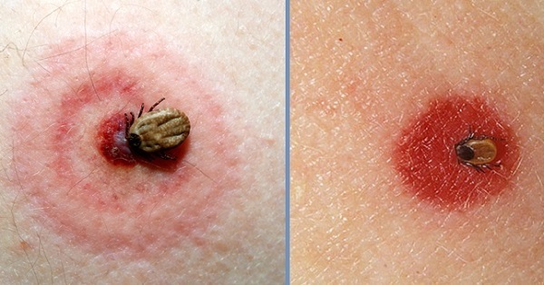 Isırıkta kızarıklık varsa - bu normal bir alerjik reaksiyon olabilir. Ancak 10-12 cm çapa ulaşan kırmızı lekeler Lyme hastalığının bir belirtisi olabilir.