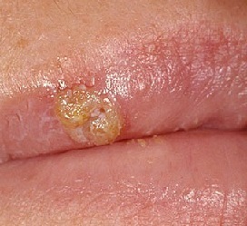 Hoe snel herpes op de lippen thuis genezen?