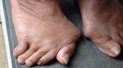 Osteoartrite dos sintomas do pé