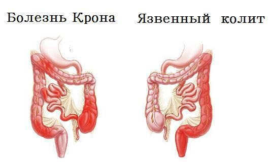Crohns sjukdomsfoto