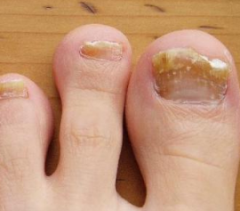 nail fungus neglected form treatment