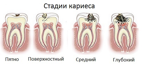 Tandkaries - foto, förebyggande och behandling