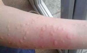 Alergija na mraz na obrazu in rokah - simptomi in zdravljenje, foto