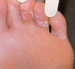 Fungus of foot symptoms