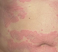 Allergic urticaria on the stomach