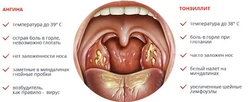 Chronic tonsillitis: photos, symptoms and treatment in adults