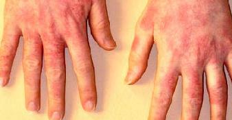Red rash in the hands of an adult: photo description