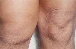 Artrite del trattamento articolare del ginocchio
