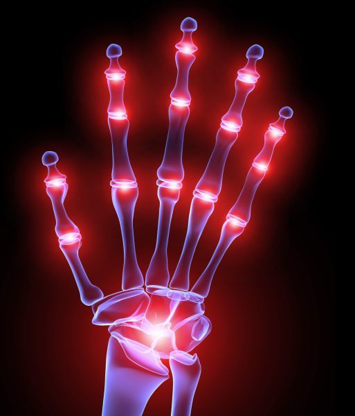 L'arthrite des mains et des doigts: qu'est-ce que c'est? Méthodes de traitement