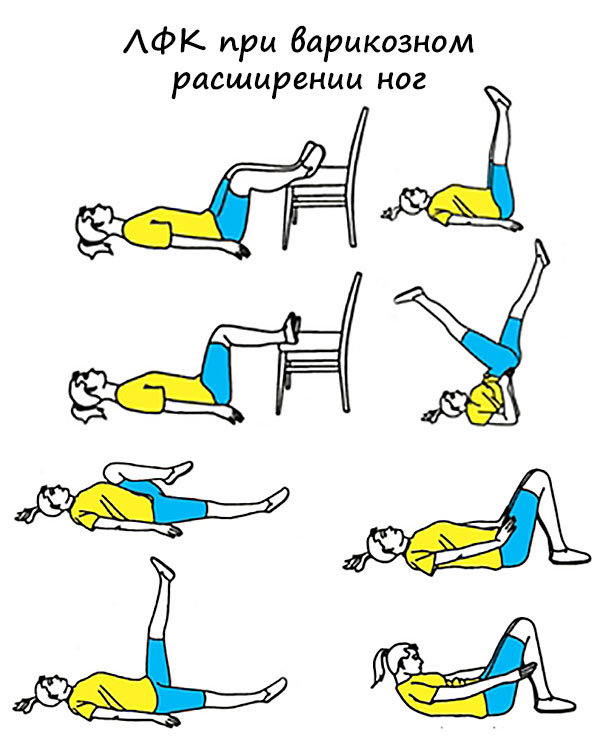 Профилактика Варикоза Лечение