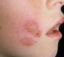 Herpes on face photo