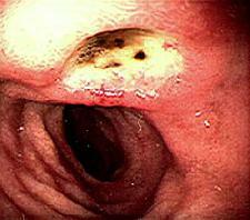 Ulcera duodenuma