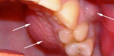 Tratamiento de periodontitis