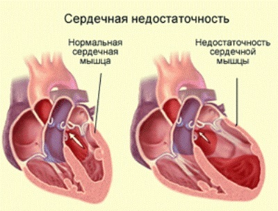 Kronični vzroki srčnega popuščanja