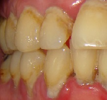 Parodontna bolest