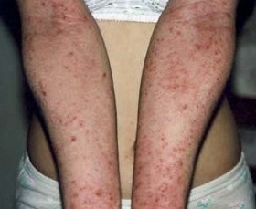 Neurodermatitis in the arms