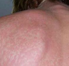 Scarlet fever in adults photo